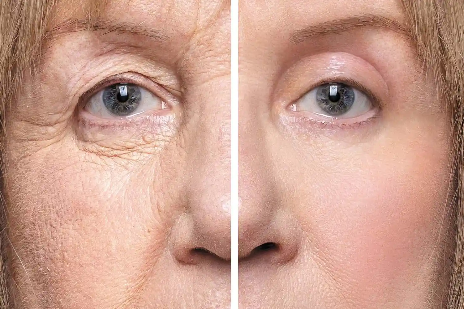 Understanding Upper Blepharoplasty: What You Need to Know