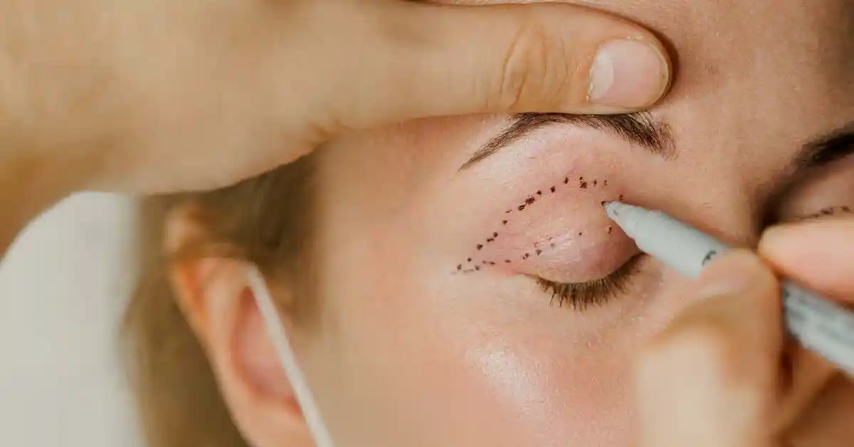 Upper Blepharoplasty Eyelid Surgery Diagram