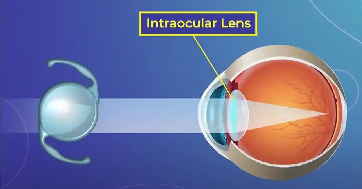 The Evolution and Benefits of the IC-8 Small Aperture Intraocular Lens